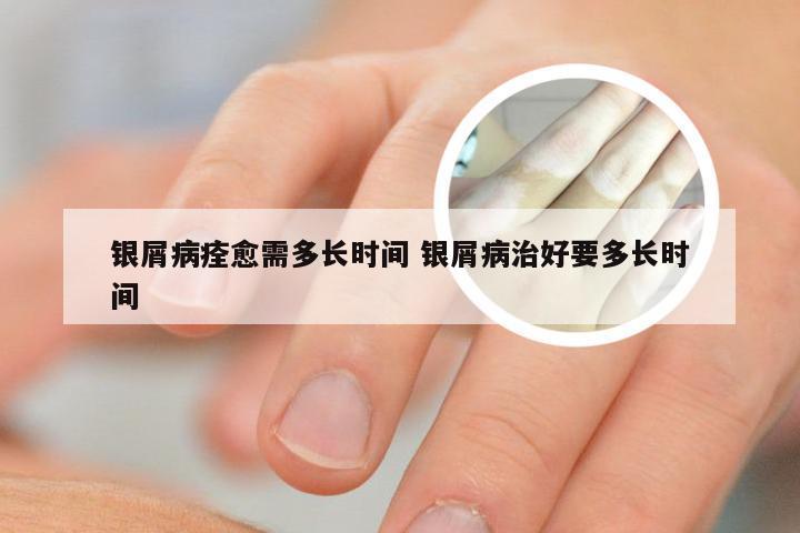 银屑病痊愈需多长时间 银屑病治好要多长时间