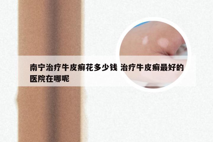 南宁治疗牛皮癣花多少钱 治疗牛皮癣最好的医院在哪呢