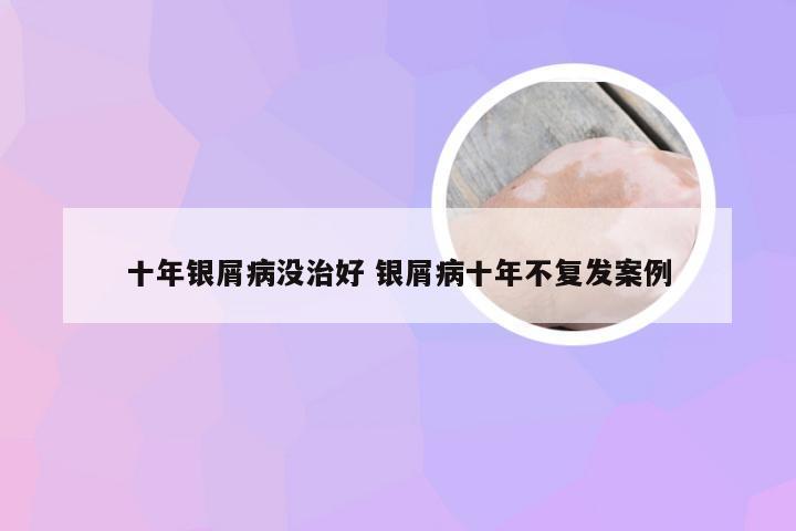 十年银屑病没治好 银屑病十年不复发案例