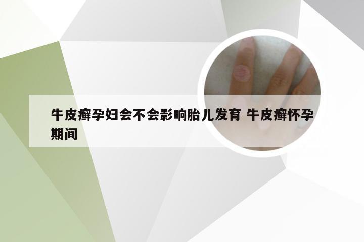 牛皮癣孕妇会不会影响胎儿发育 牛皮癣怀孕期间
