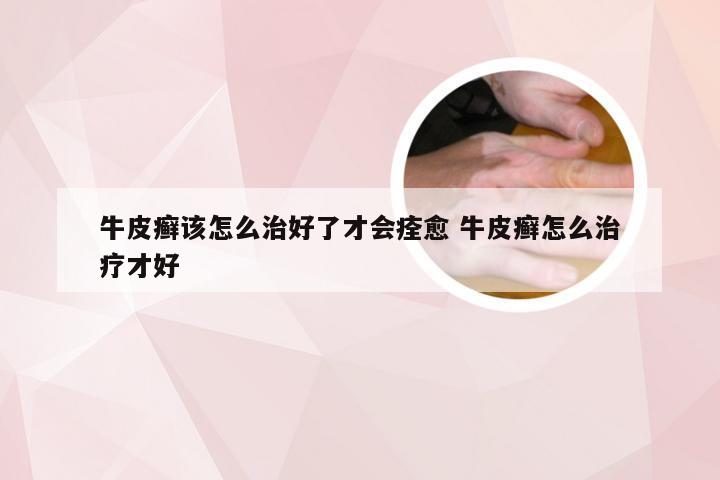 牛皮癣该怎么治好了才会痊愈 牛皮癣怎么治疗才好