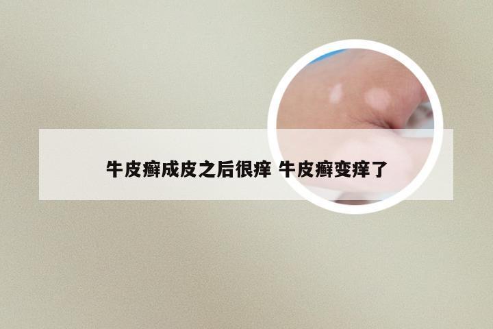 牛皮癣成皮之后很痒 牛皮癣变痒了
