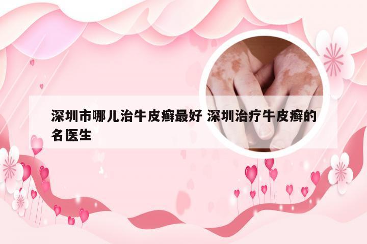 深圳市哪儿治牛皮癣最好 深圳治疗牛皮癣的名医生