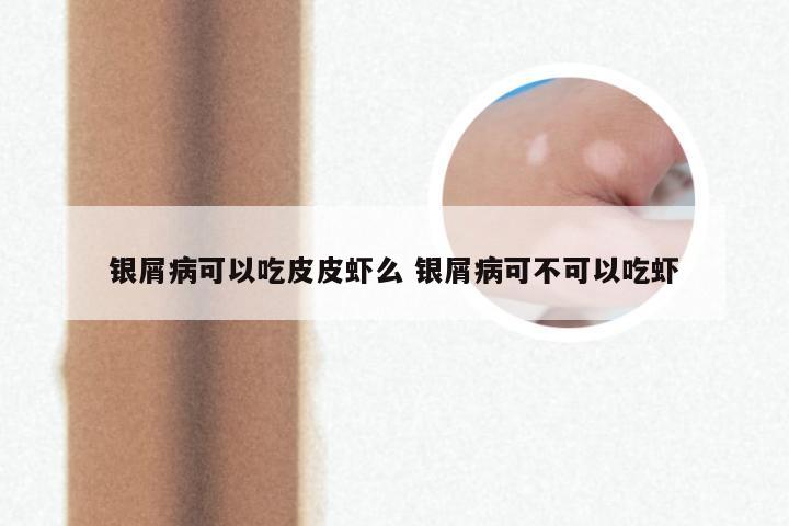 银屑病可以吃皮皮虾么 银屑病可不可以吃虾