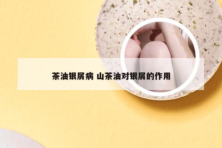 茶油银屑病 山茶油对银屑的作用