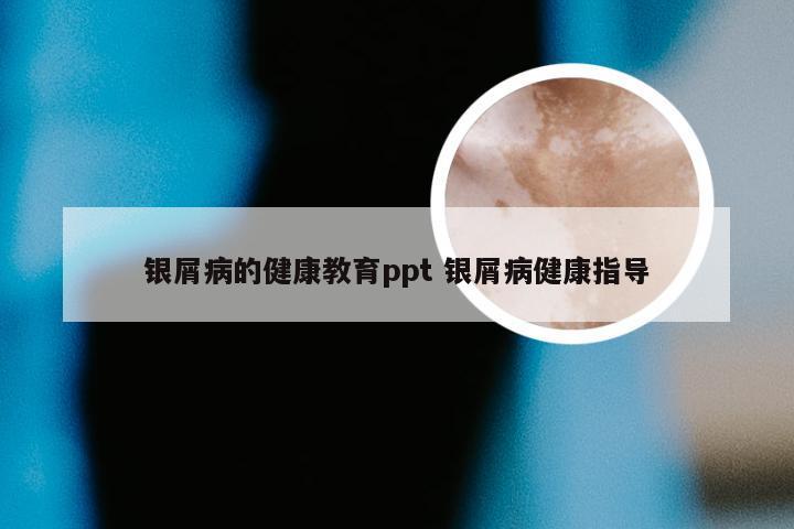 银屑病的健康教育ppt 银屑病健康指导