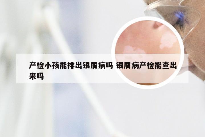 产检小孩能排出银屑病吗 银屑病产检能查出来吗