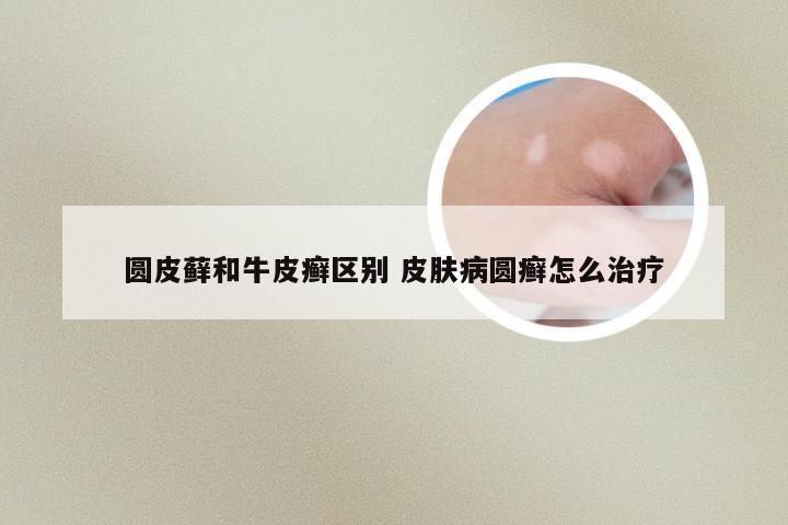 圆皮藓和牛皮癣区别 皮肤病圆癣怎么治疗