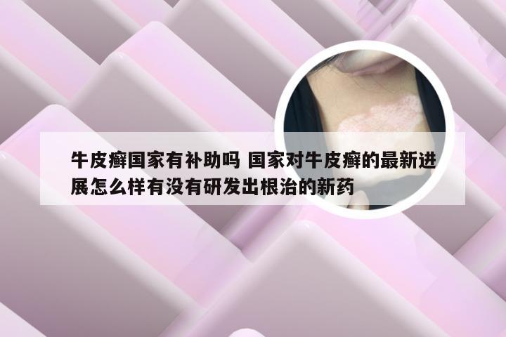 牛皮癣国家有补助吗 国家对牛皮癣的最新进展怎么样有没有研发出根治的新药