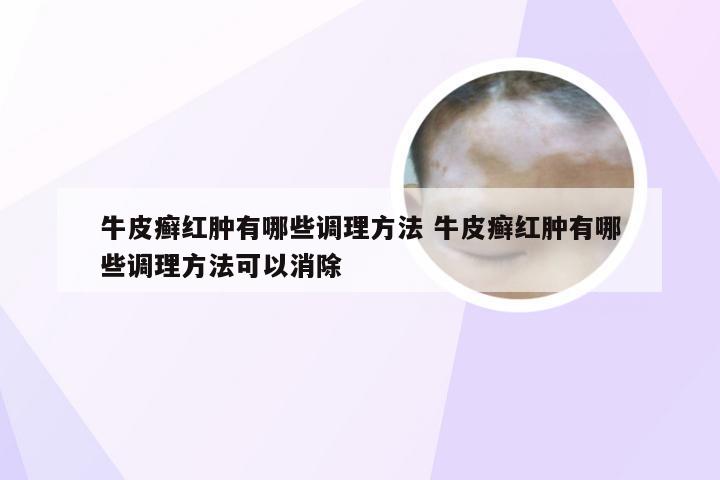 牛皮癣红肿有哪些调理方法 牛皮癣红肿有哪些调理方法可以消除