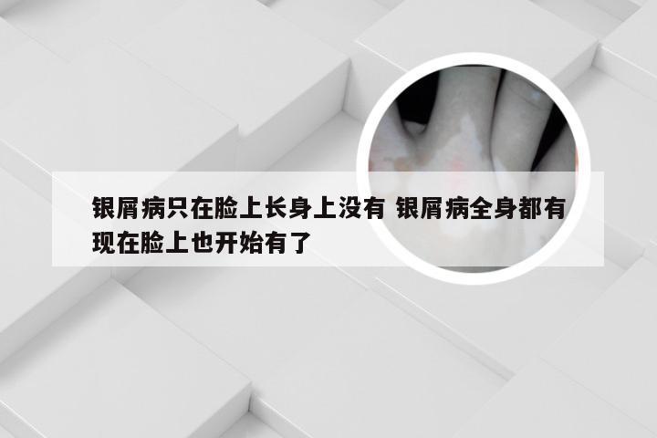 银屑病只在脸上长身上没有 银屑病全身都有现在脸上也开始有了