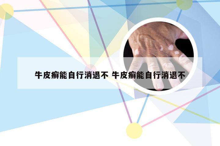 牛皮癣能自行消退不 牛皮癣能自行消退不