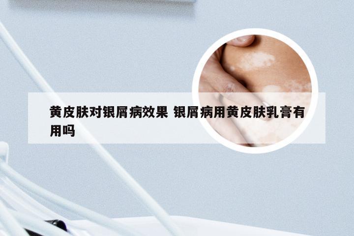 黄皮肤对银屑病效果 银屑病用黄皮肤乳膏有用吗