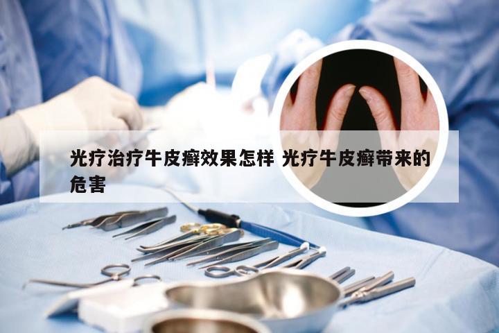 光疗治疗牛皮癣效果怎样 光疗牛皮癣带来的危害