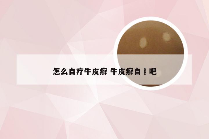 怎么自疗牛皮癣 牛皮癣自癒吧