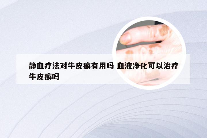 静血疗法对牛皮癣有用吗 血液净化可以治疗牛皮癣吗