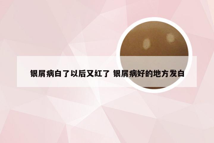 银屑病白了以后又红了 银屑病好的地方发白