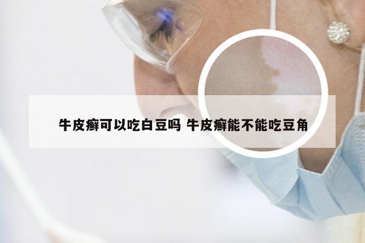 牛皮癣可以吃白豆吗 牛皮癣能不能吃豆角