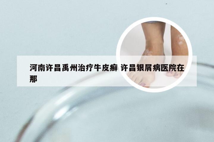 河南许昌禹州治疗牛皮癣 许昌银屑病医院在那