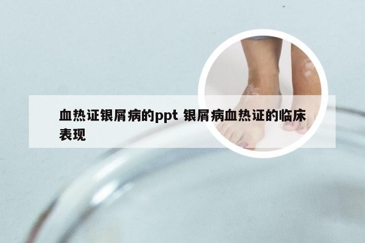 血热证银屑病的ppt 银屑病血热证的临床表现