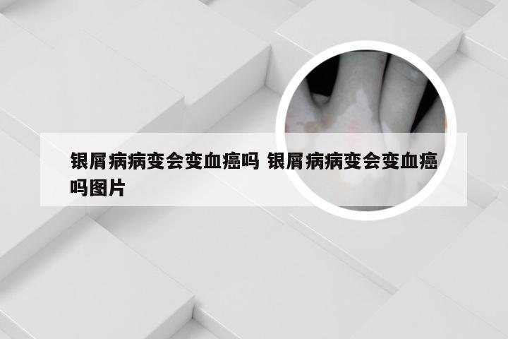 银屑病病变会变血癌吗 银屑病病变会变血癌吗图片
