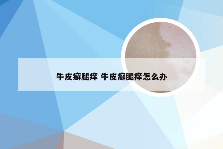 牛皮癣腿痒 牛皮癣腿痒怎么办
