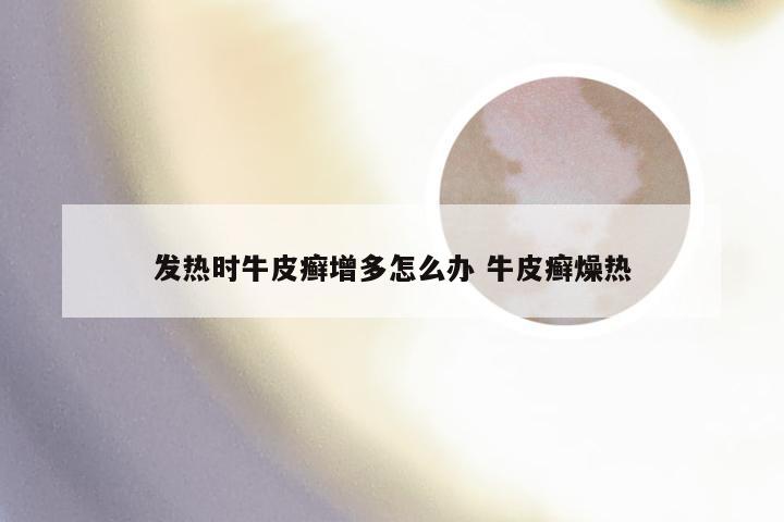 发热时牛皮癣增多怎么办 牛皮癣燥热