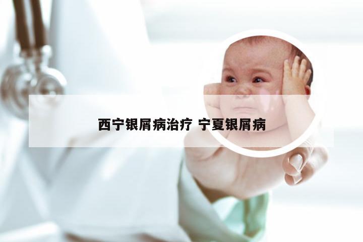 西宁银屑病治疗 宁夏银屑病