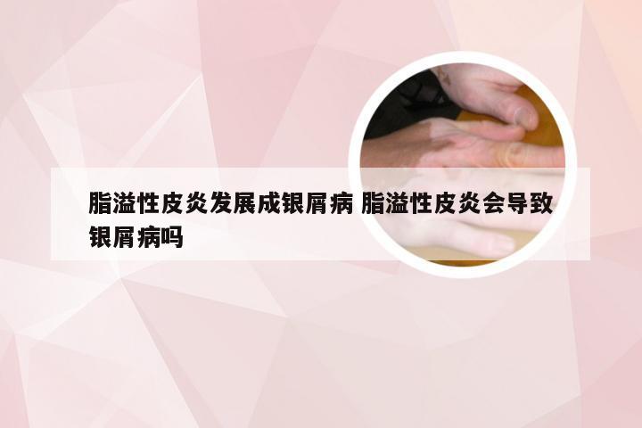 脂溢性皮炎发展成银屑病 脂溢性皮炎会导致银屑病吗