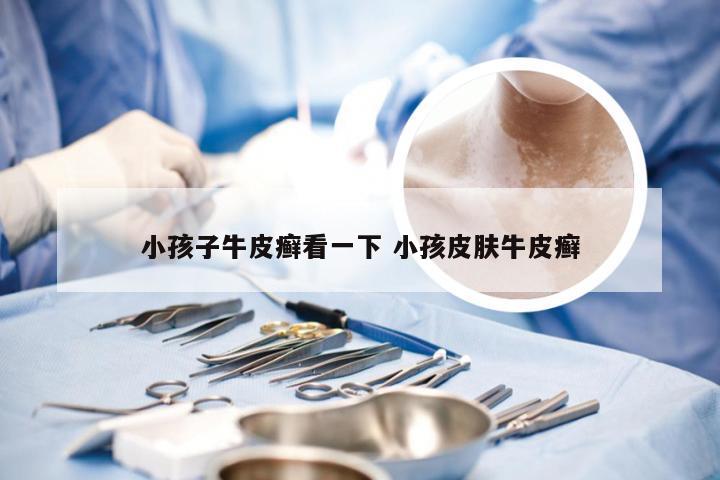 小孩子牛皮癣看一下 小孩皮肤牛皮癣