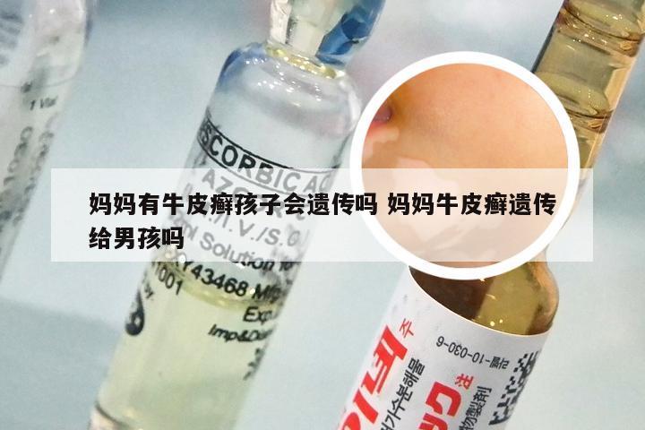 妈妈有牛皮癣孩子会遗传吗 妈妈牛皮癣遗传给男孩吗