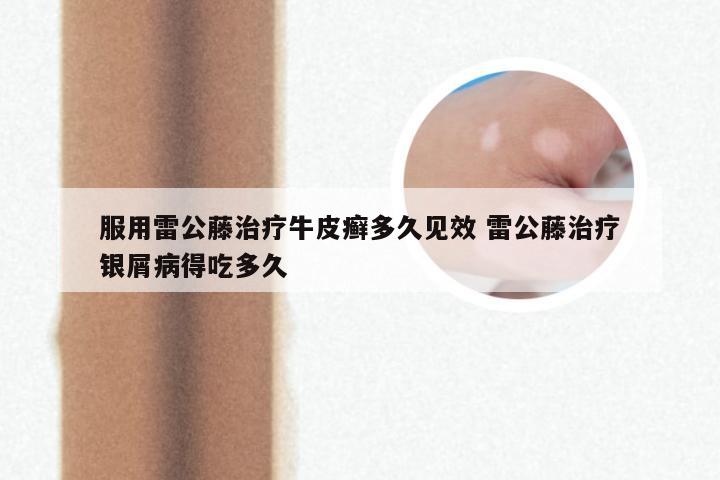 服用雷公藤治疗牛皮癣多久见效 雷公藤治疗银屑病得吃多久