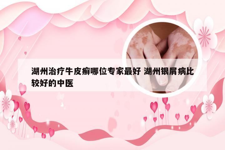 湖州治疗牛皮癣哪位专家最好 湖州银屑病比较好的中医