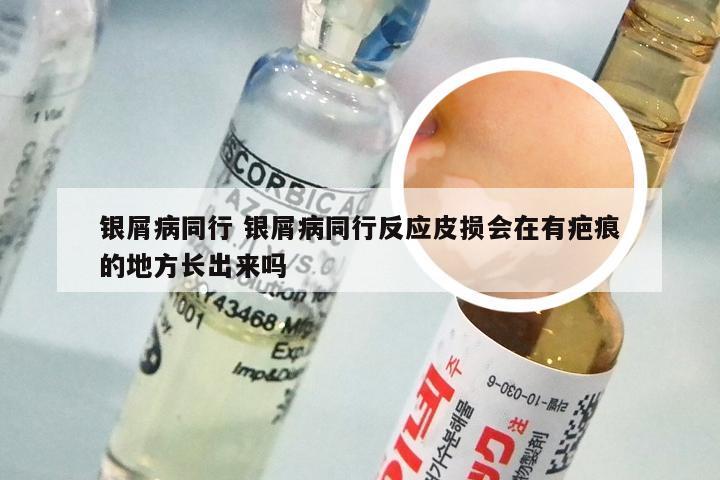 银屑病同行 银屑病同行反应皮损会在有疤痕的地方长出来吗
