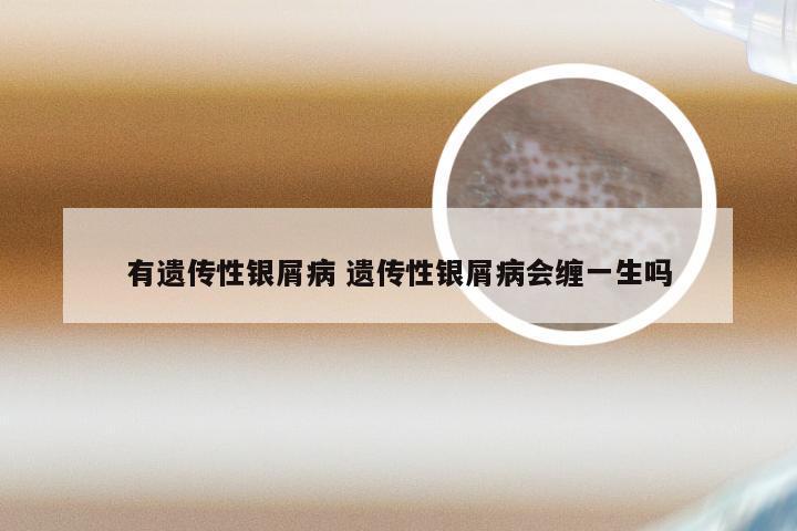 有遗传性银屑病 遗传性银屑病会缠一生吗
