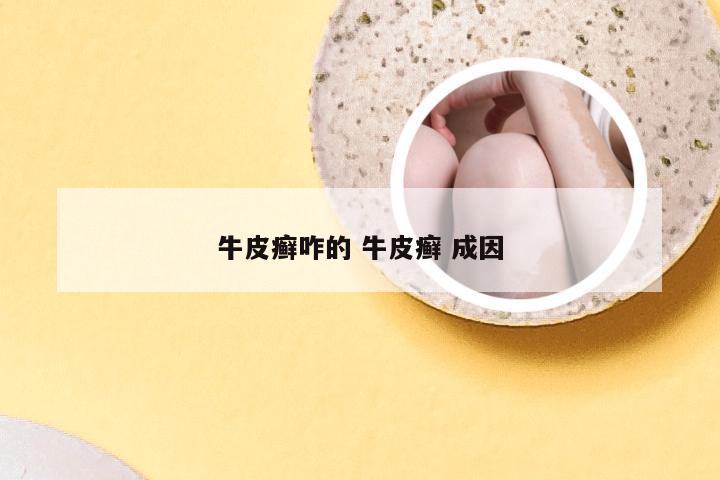 牛皮癣咋的 牛皮癣 成因