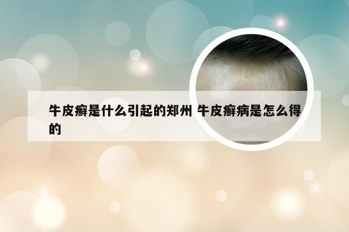 牛皮癣是什么引起的郑州 牛皮癣病是怎么得的