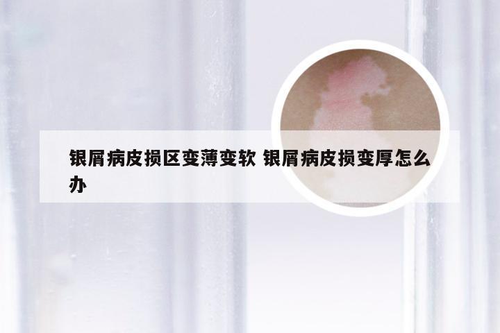银屑病皮损区变薄变软 银屑病皮损变厚怎么办