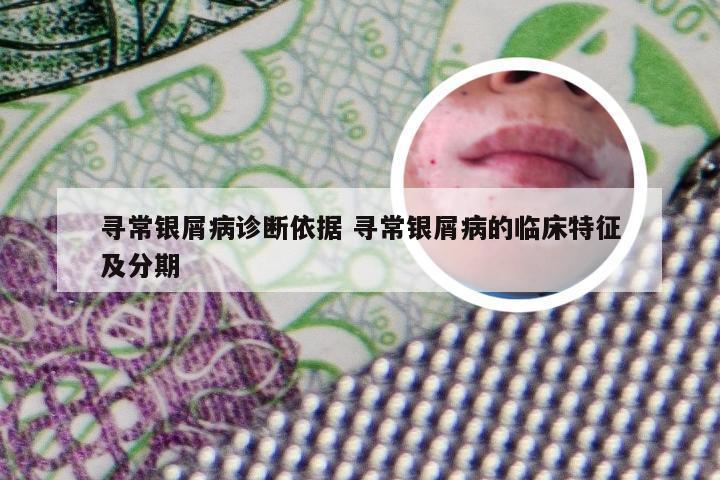 寻常银屑病诊断依据 寻常银屑病的临床特征及分期