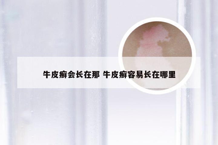 牛皮癣会长在那 牛皮癣容易长在哪里
