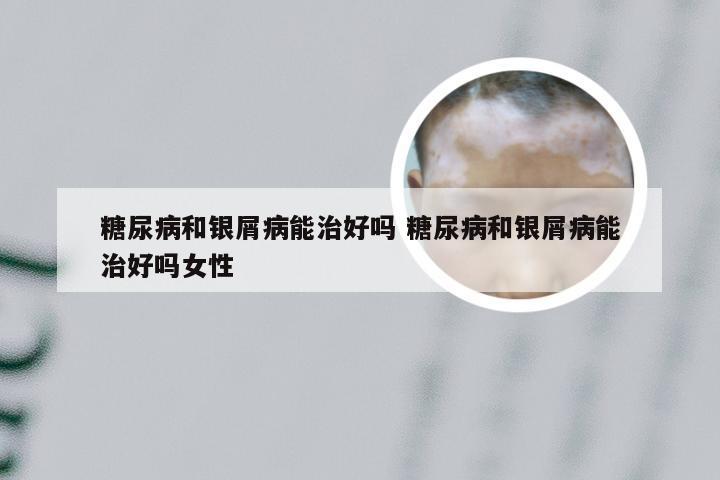 糖尿病和银屑病能治好吗 糖尿病和银屑病能治好吗女性