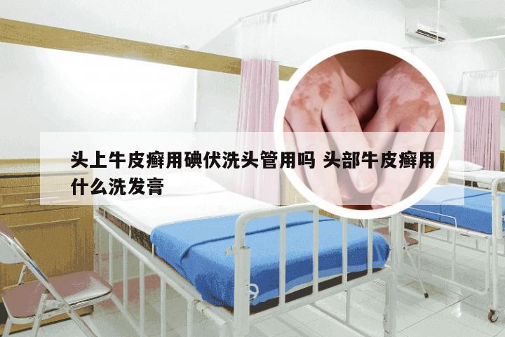 头上牛皮癣用碘伏洗头管用吗 头部牛皮癣用什么洗发膏