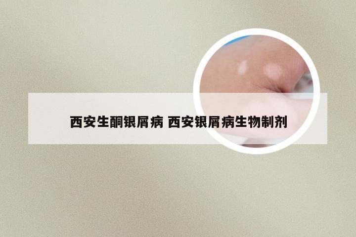 西安生酮银屑病 西安银屑病生物制剂