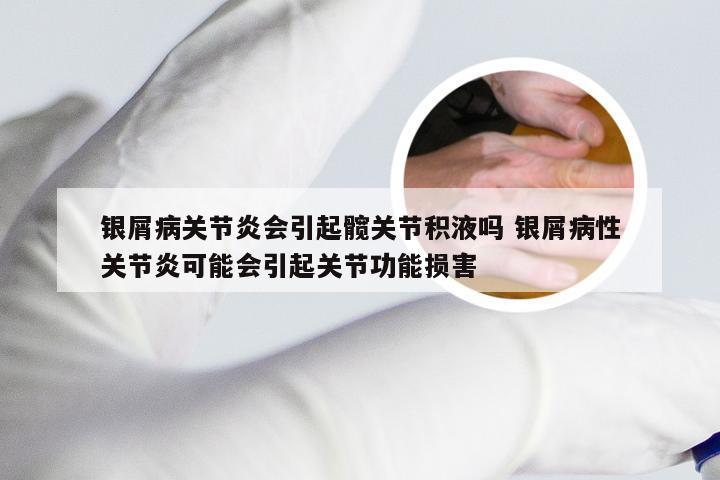 银屑病关节炎会引起髋关节积液吗 银屑病性关节炎可能会引起关节功能损害