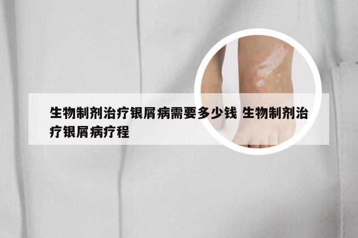 生物制剂治疗银屑病需要多少钱 生物制剂治疗银屑病疗程
