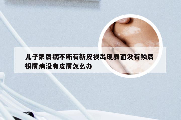 儿子银屑病不断有新皮损出现表面没有鳞屑 银屑病没有皮屑怎么办