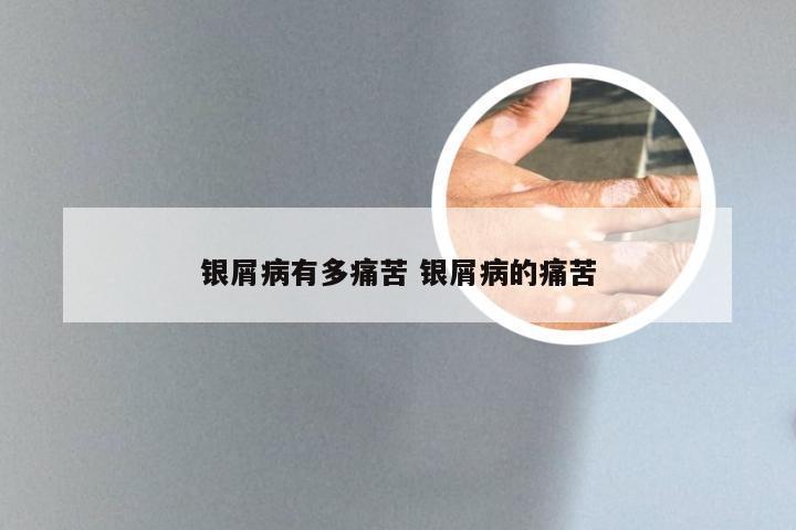 银屑病有多痛苦 银屑病的痛苦