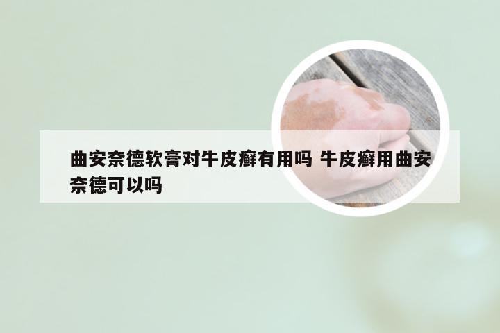 曲安奈德软膏对牛皮癣有用吗 牛皮癣用曲安奈德可以吗