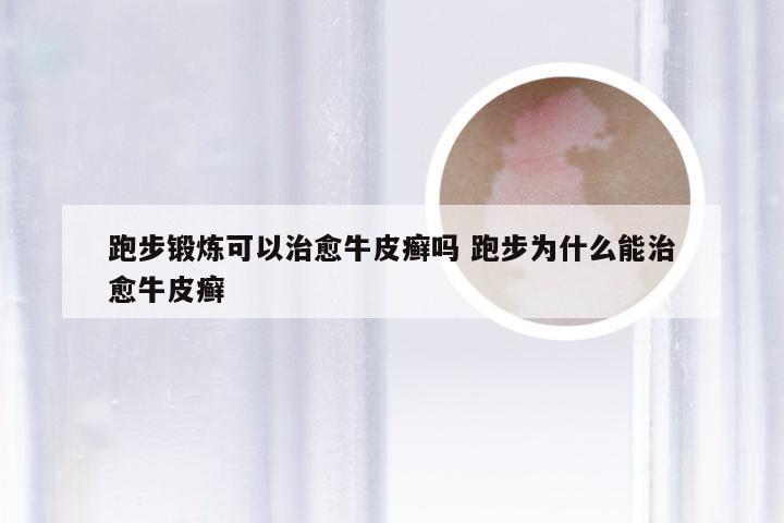 跑步锻炼可以治愈牛皮癣吗 跑步为什么能治愈牛皮癣