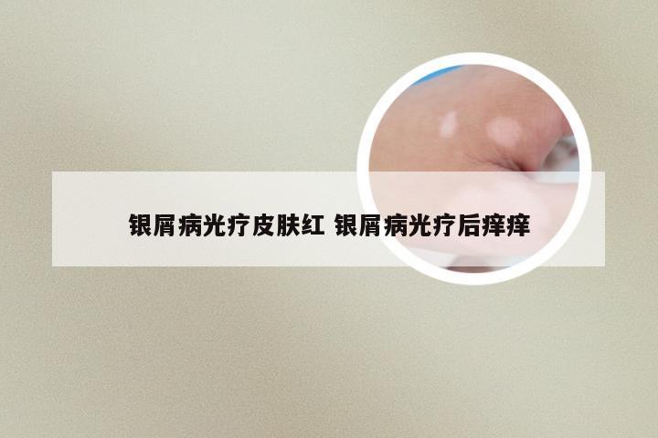 银屑病光疗皮肤红 银屑病光疗后痒痒